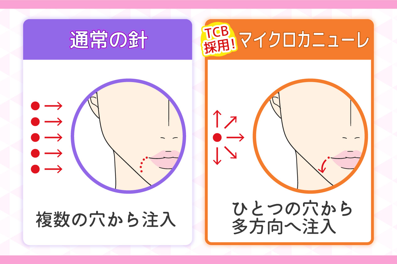 TCBヒアルロン酸注射の特徴